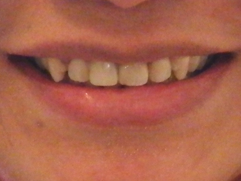 Partial denture with one tooth
