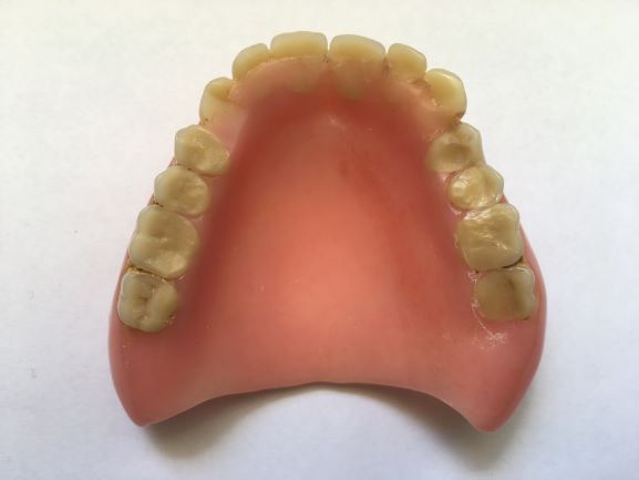 Upper full acrylic denture repaired 