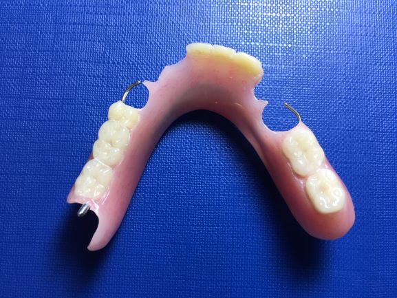 Partial denture for front teeth and back teeth